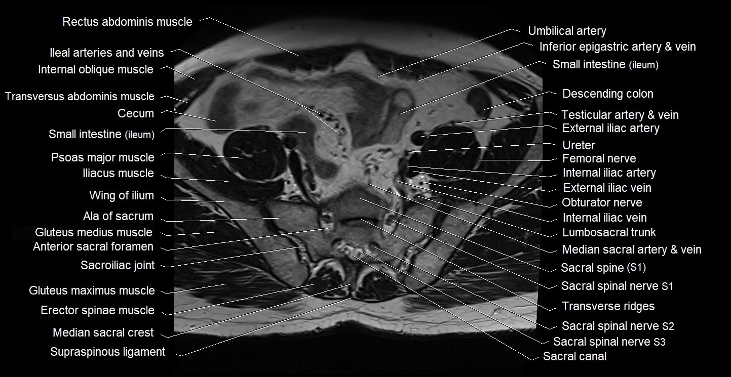Male pelvis axial cross sectional anatomy image 3.webp